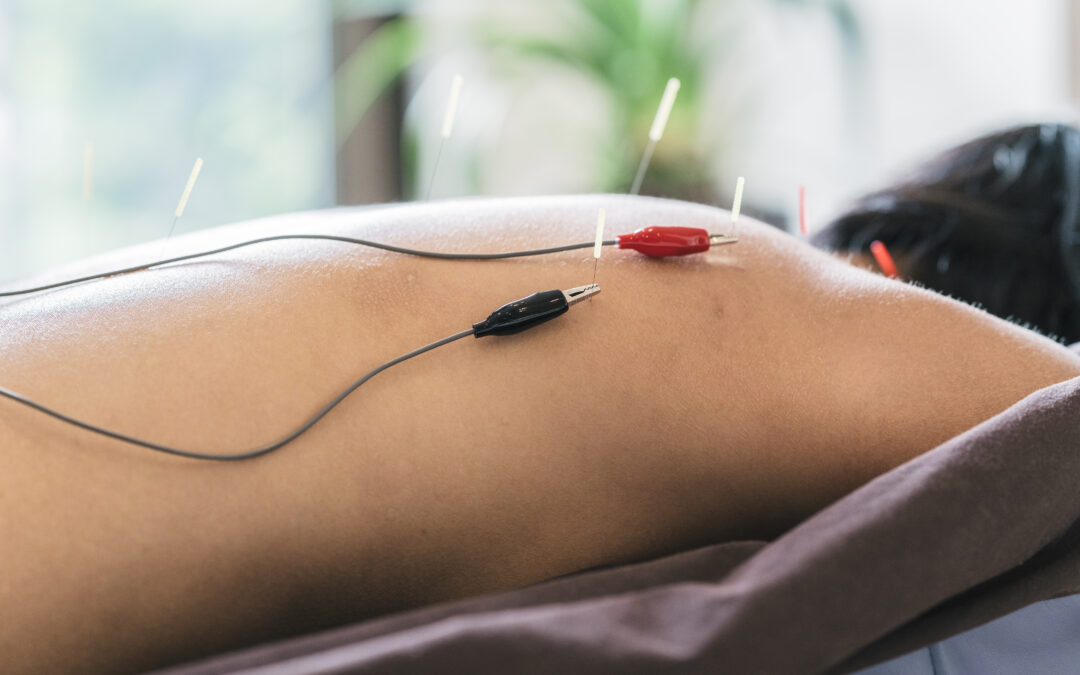 Acupuncture